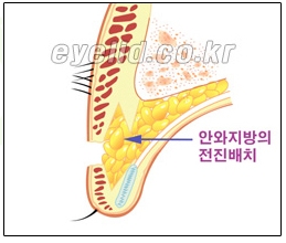 [두한성형외과 쌍꺼풀재수술] - [쌍꺼풀재수술성공요건, 쌍꺼풀재수술과정] 관련 이미지 13