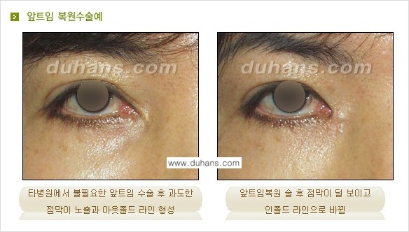 [두한성형외과 눈성형 FOCUS] - [몽고주름 제거(앞트임 제거) 수술 ③] 관련 이미지 5