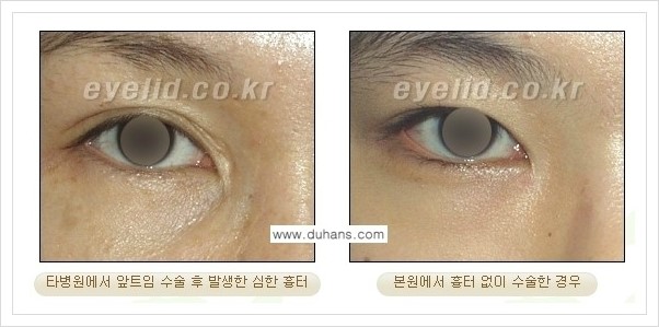 [두한성형외과 경쟁력 눈성형] - [몽고주름 제거수술, 앞트임 수술 안내] 관련 이미지 4