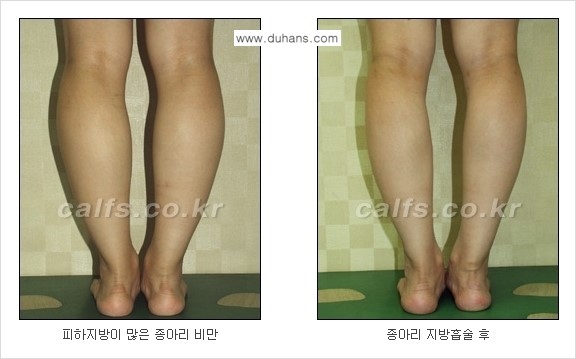 ⁠⁠[두한성형외과 경쟁력 멀티종아리성형] - [지방흡입이 필요한 종아리 비만 안내] 관련 이미지 10