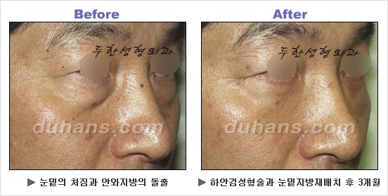[두한성형외과 경쟁력 동안성형 리더] - ​[미간주름, 이마주름, 안검성형, 이마거상술, 눈썹거상술] 관련 이미지 100