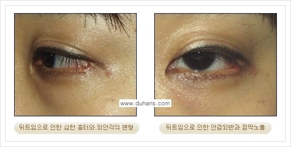 [두한성형외과 경쟁력 눈성형] - [앞트임 복원수술, 뒤트임 수술 안내] 관련 이미지 8