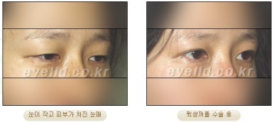 [Double Eyelid Surgery Duhan Plastic Surgery] - [Buried Method, Incision Method, Partial Incision Method] image 26