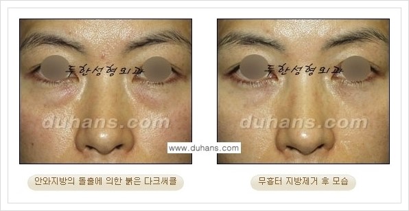 [두한성형외과 경쟁력 안검성형] - [눈밑 지방제거 안내] 관련 이미지 7