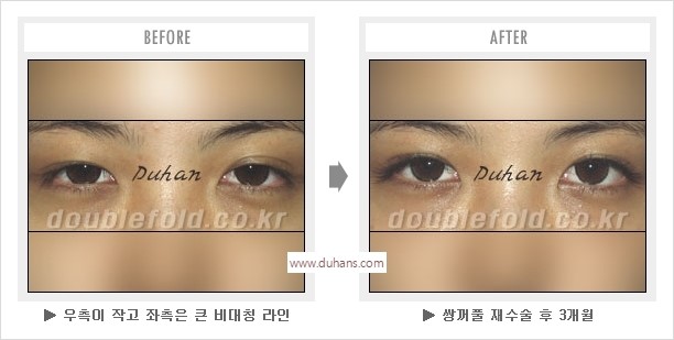 [두한성형외과 경쟁력 눈성형] - [나에게 맞는 어울리는 쌍꺼풀 라인] 관련 이미지 40