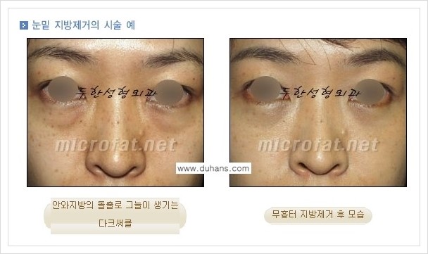 [두한성형외과 경쟁력 눈밑성형] - [눈밑지방제거, 눈위지방제거 안내 1.] 관련 이미지 11
