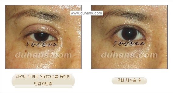 [두한성형외과 경쟁력 눈성형] - [두꺼운 라인을 교정하는 극한 눈 재수술 1.] 관련 이미지 13