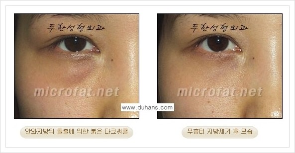 [두한성형외과 경쟁력 눈밑성형] - [눈밑지방제거, 눈위지방제거 안내 2.] 관련 이미지 16