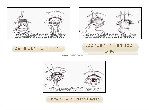 [두한성형외과 경쟁력 쌍꺼풀 재수술(극한 재수술)] - [안검하수(졸리운 눈매) 교정 안내 2.] 관련 이미지 7