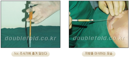 [Duhan Plastic Surgery Revision Double Eyelid Surgery] - [Double Eyelid Revision Surgery Process] image 32