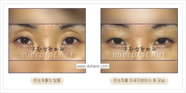 [두한성형외과의 경쟁력 미세지방이식] - [꺼진 눈꺼풀(윗눈꺼풀 함몰) 미세지방이식 안내] 관련 이미지 4