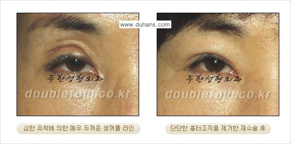 [두한성형외과 경쟁력 쌍꺼풀 재수술, 극한 재수술] - [쌍꺼풀 재수술로 인해 흉살이 두터운 경우] 관련 이미지 2