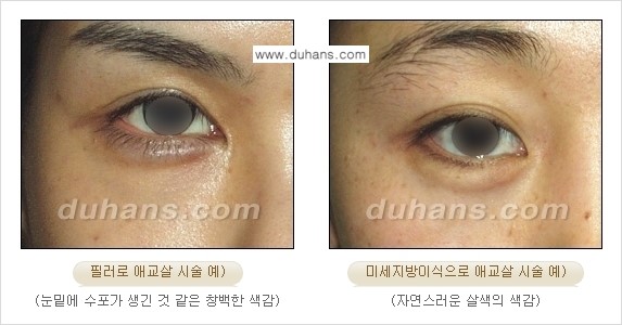 [두한성형외과 경쟁력 미세지방이식] - [눈밑 애교살을 위한 미세지방이식 1.] 관련 이미지 12
