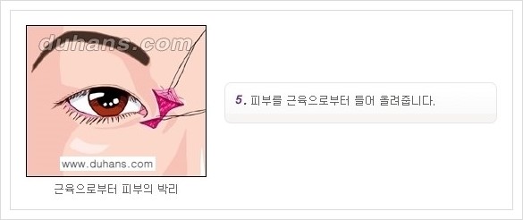 [두한성형외과 경쟁력 눈성형] - [앞트임 수술(몽고주름 제거) 안내 ②] 관련 이미지 5