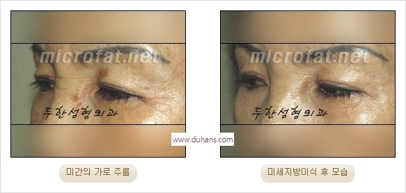 [두한성형외과 경쟁력 동안성형 리더] - ​[미간주름, 이마주름, 안검성형, 이마거상술, 눈썹거상술] 관련 이미지 20