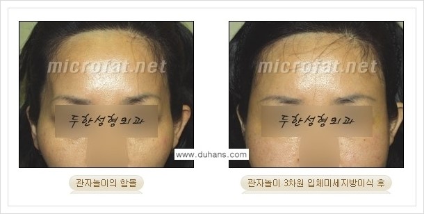 ⁠[두한성형외과 경쟁력 미세지방이식] - [상표등록 "Col-fat(콜펫) 지방이식"으로 교정이 가능한 부위] 관련 이미지 4