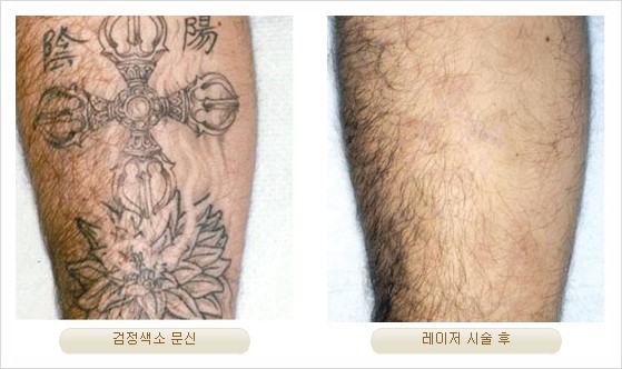 [두한성형외과 경쟁력 안전성형] - [최첨단 장비를 이용한 흉터, 점, 주근깨, 잡티, 문신제거 레이저 시술] 관련 이미지 31