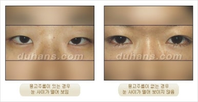 [Duhan Plastic Surgery Double Eyelid Revision Surgery] - [Partial Incision Method and Epicanthoplasty] image 45