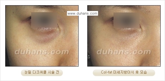 [두한성형외과 경쟁력 미세지방이식] - [탄력있는 피부와 윤곽을 만들어주는 Col-fat 지방이식] 관련 이미지 9