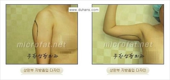 [두한성형외과 경쟁력 바디성형] - [하복부, 팔뚝, 허리선, 허벅지, 엉덩이 간편지방흡입술] 관련 이미지 6