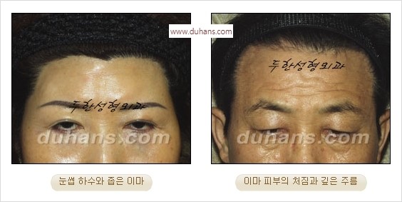 [두한성형외과 경쟁력 주름성형] - [간단하면서 자연스러운 주름제거 방법] 관련 이미지 6