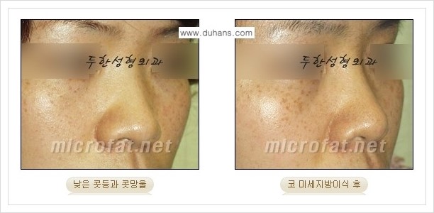 ⁠[두한성형외과 경쟁력 미세지방이식] - [상표등록 "Col-fat(콜펫) 지방이식"으로 교정이 가능한 부위] 관련 이미지 7