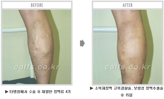 [종아리성형 두한성형외과] - [종아리수술에 대한 자주하는 질문과 답변 모음] 관련 이미지 13