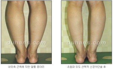 [두한성형외과 종아리 퇴축] - [종아리 퇴축술 재발 재수술] 관련 이미지 23