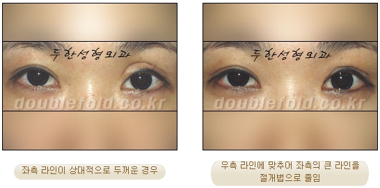 [Duhan Plastic Surgery Double Eyelid Revision Surgery] - [Ptosis Correction Surgery] image 49