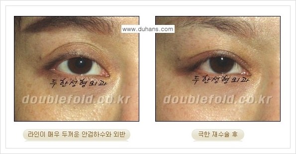 [두한성형외과 경쟁력 쌍꺼풀 재수술, 극한 눈재수술] - [쌍꺼풀 재수술, 극한 눈재수술 관련 자주하는 질문과 답변] 관련 이미지 9