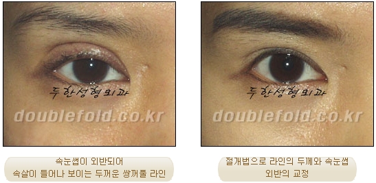 [두한성형외과 쌍커풀수술] - [눈성형 방법에 대한 자주하는 질문과 답변] 관련 이미지 58