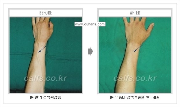 [두한성형외과 정맥류 치료] - [손, 팔 정맥확장증 사진자료 안내 ①] 관련 이미지 7