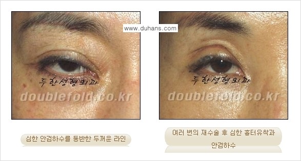 [두한성형외과 경쟁력 쌍꺼풀 재수술, 극한 눈재수술] - [망친 쌍꺼풀을 복원하는 극한 눈재수술] 관련 이미지 2