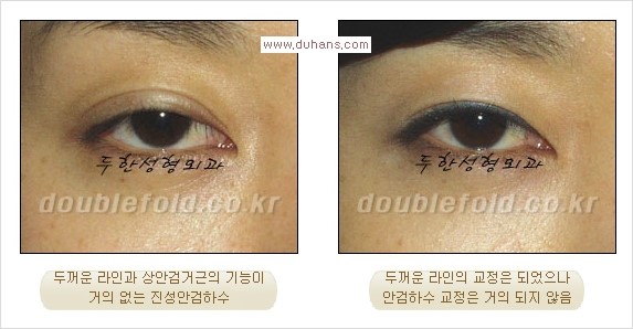 ⁠⁠[두한성형외과 경쟁력 쌍꺼풀 재수술] - [재수술 대상과 재수술의 문제점] 관련 이미지 17