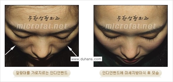 [두한성형외과의 경쟁력 미세지방이식] - [귀족수술과 인디언밴드 미세지방이식 안내 ③] 관련 이미지 8