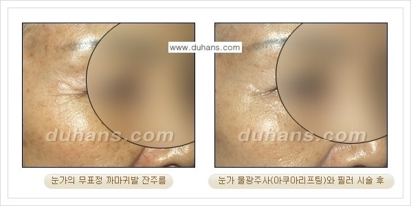 [두한성형외과 경쟁력 주름성형] - [미간주름, 눈가주름, 눈밑주름 제거 시술 안내] 관련 이미지 4