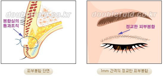 [두한성형외과 쌍커풀재수술] - [심한 소세지눈, 두줄따기, 쌍꺼풀 흉터] 관련 이미지 14