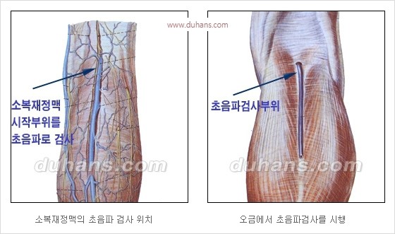 [두한성형외과 경쟁력 정맥류 치료] - [정맥류 치료의 모든 것] 관련 이미지 7