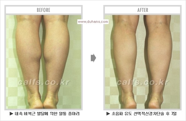 [두한성형외과 경쟁력 멀티종아리성형] - [알통종아리 해결 - 비절개 초음파 선택적 신경차단술] 관련 이미지 18