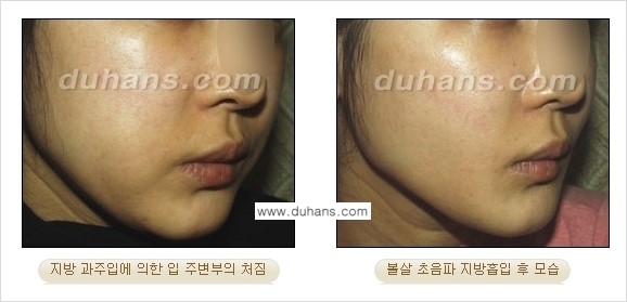 ​​​﻿[두한성형외과 경쟁력 간편지방흡입] - [볼살지방흡입, 턱선지방흡입 시술 과정의 안내] 관련 이미지 8