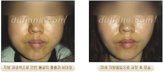 [두한성형외과 얼굴자가지방이식] - [볼살, 이마, 측두부] 관련 이미지 43