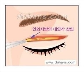 [두한성형외과 경쟁력 쌍꺼풀 재수술, 극한 눈재수술] - [쌍꺼풀 재수술, 눈재수술 실패의 원인 안내] 관련 이미지 5