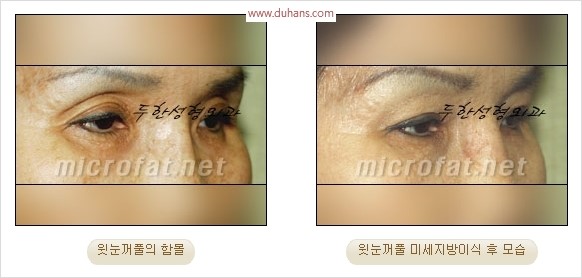 [두한성형외과 경쟁력 눈성형 리더] - [윗눈꺼풀 함몰( #꺼진눈꺼풀) 미세지방이식과 상안검성형]#꺼진눈성형 , #눈위함몰 관련 이미지 32