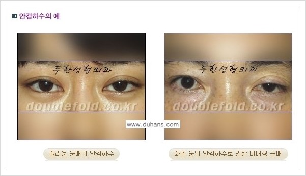 [두한성형외과 경쟁력 쌍꺼풀 재수술(극한 재수술)] - [안검하수(졸리운 눈매) 교정 안내 1.] 관련 이미지 1