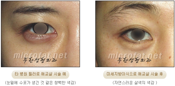 [두한성형외과 지방이식] - [다크서클, 눈밑주름] 관련 이미지 95
