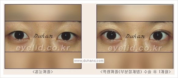 [두한성형외과 경쟁력 눈성형, 쌍꺼풀 수술] - [퀵쌍꺼풀(부분절개법)의 수술 안내] 관련 이미지 12