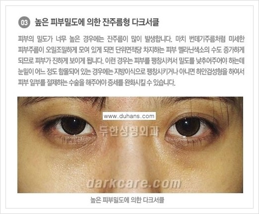[두한성형외과 경쟁력 눈밑성형] - [다크써클의 종류] 관련 이미지 4