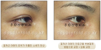 [Duhan Plastic Surgery Reoperation for Double Eyelids] - [Lowering the Double Eyelid Line] image 26