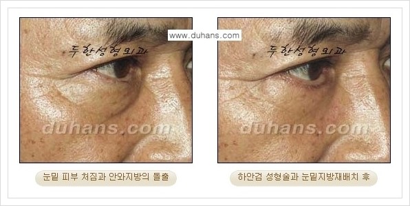 [두한성형외과 경쟁력 눈성형] - [젊은 눈매로의 복원 안검성형] 관련 이미지 30