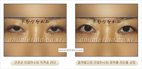 [두한성형외과 경쟁력 눈성형] - [안검하수(졸린눈매) 눈매교정 여러 가지 방법 안내] 관련 이미지 16